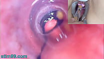 porn зрелая женщина эндоскопическая камера peehole в мочевом пузыре с шариками porn