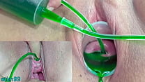 porn cervix and pee hole inflation with injections for japanese lesbians porn